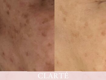 クラルテ(CLARTE)/シミ改善とトーンアップ☆