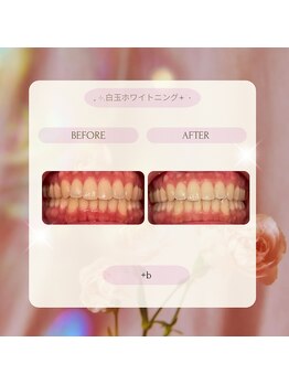 プラスビーセルフ(+b self)/ホワイトニングビフォーアフター