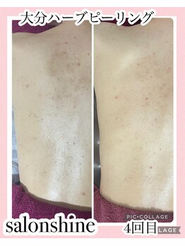 サロンシャイン(Salon Shine)/ハード背中