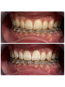 エクシアホワイトニング 日本橋店/矯正中の方でも^_^