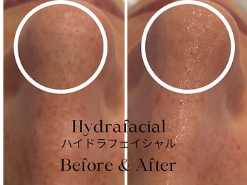 トウキョウビューティーラボ(TOKYO BEAUTY LABO.)/ハイドラBefore&After