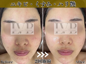 ラヴレボーテ(La Vraie Beaute)/敏感肌可◎ハーブピーリング
