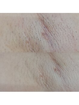 RiとBiのたまご/（脱毛）ワキ 7月～10月