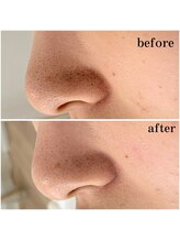 プラセル(Placer)/これ辞めた☆/札幌/毛穴/北区