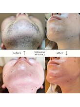 スプランドゥール(Splendeur)/レディース顔　ワックス＋光脱毛