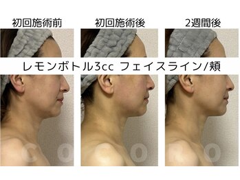 ココロ(COCORO)/しぶといたるみはレモンボトル