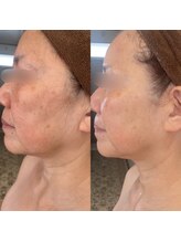 ヴィアス(Vias)/シリカ