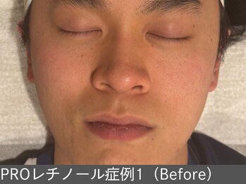 オアシスラグーン(OASIS LAGOON)/レチノール(症例1 before)