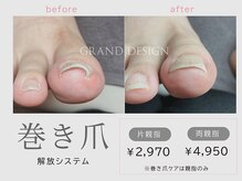 痛みの少ない【巻き爪ケア】レジスタンスプレート導入サロン。ジェルネイルも同時にOK♪