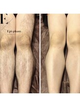 エピファニー(Epi phany Total Beauty Salon)/憧れのチクチクしない肌長持ち