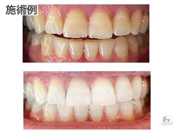 リングベリー 湘南茅ヶ崎(Ring Beauty)の写真/【歯科医監修サロン】セルフホワイトニング初回限定¥3980♪個室完備/都度払いOK♪ブライダル前におすすめ◎