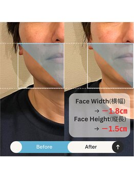 ブルハ(Bruja)/小顔矯正『コルギ』A2