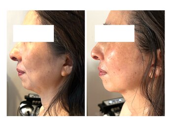 エルブラン(Herb ame)/ラジオ波ハンドでお顔の脂肪分解