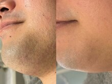 モナートドゥ(Monartdeux)/メンズ髭脱毛