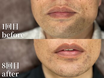 ボス 名古屋店(BOSS)/【ヒゲ脱毛　before & after】