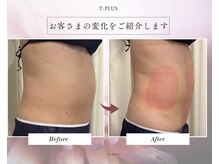 ティープラス 大和鶴間店(T-PLUS)の雰囲気（【エステ】脂肪冷却痩身-5cm☆施術1回ビフォーアフター写真）