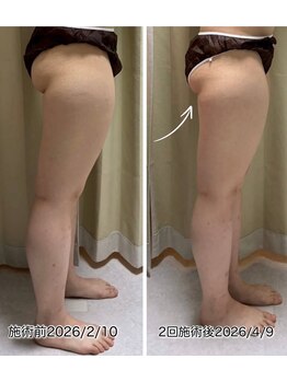 クールスパ(COOL SPA)/【20代女性】ヒップ症例