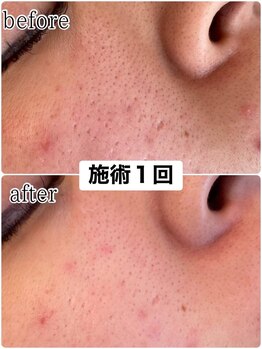 ラディア(Radia.)の写真/表面の汚れだけじゃなく真皮まで届く！剥離ありだからできる毛穴ケアで理想の肌へ★