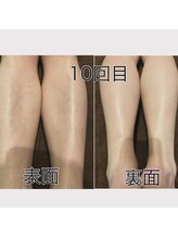 レイモード(Ray mode)/メンズ全身脱毛♪VIOありコース