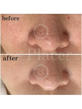 プラセル(Placer)/深い毛穴開き/札幌/北区/毛穴