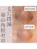 毛穴レス【黒ずみ、ニキビケア】毛穴洗浄高濃度ビタミンCで引き締め/¥6,600