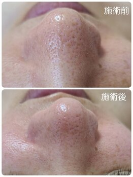 キレイ(KIREI)/毛穴に自信あり！