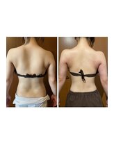 サラン鍼灸院(SARAN都楽鍼灸院)/よもぎ蒸し×エンダモロジー結果