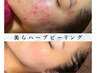 【ニキビケア毛穴】ハーブピーリング×ニキビケアパック　マッサージ付 ¥8800