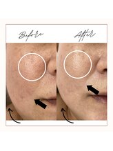 プレジール 大野城店(plaisir)/BBL光フェイシャル