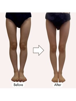 じぶんdeエステ 池袋店/骨格矯正術でO脚改善