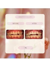 プラスビー 2号店(+b)/ホワイトニングビフォーアフター