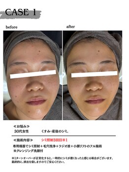 ミウル 天王寺店(miulu)/30代女性/シミ照射3回