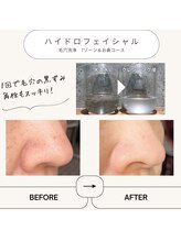 マヴィ 守口店(MavY.)/汚れが見える毛穴洗浄！