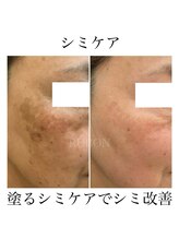 ルボン 宮崎店(RUBON)/長年のシミ改善お任せください