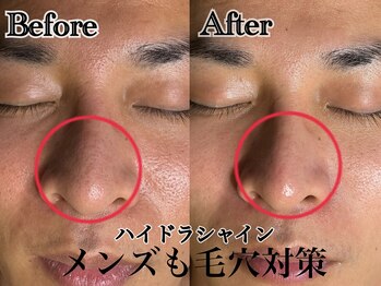 アンドエス 六本木(and S.)/男の美肌革命☆黒ずみに毛穴洗浄