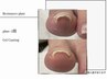  &nbsp;&nbsp;ジェルオフありフット巻き爪解放（フットネイルなし）