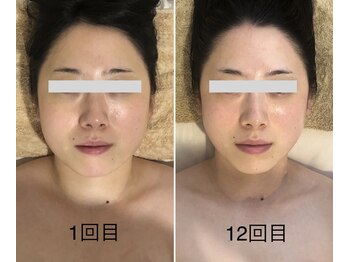 ミピマムマリール(Mipimam Marire)/Before、After