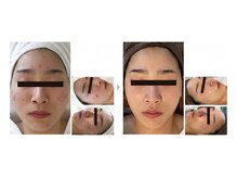 エスティーメル(ST mell)/水光肌ピーリングは肌質改善に◎