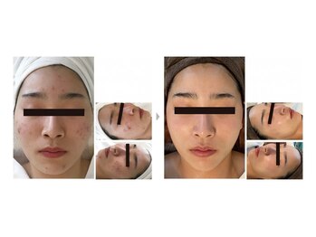 エスティーメル(ST mell)/水光肌ピーリングは肌質改善に◎