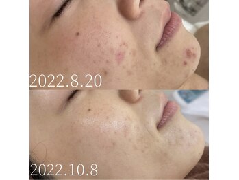 ナチュラルココ(NATURALCOCO)/陶肌トリートメントbeforafter★