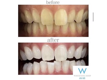 ホワイトニングショップ 山口店/山口ホワイトニング
