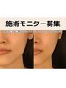 【65％OFF】1日1名限定モニター募集◆最新リフトアップ『Lifit』148000→5000