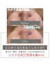 【毛穴悩み！スペシャルケア】ハイドロ毛穴洗浄+鼻WAX+針クレイパック