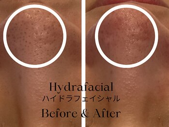 トウキョウビューティーラボ(TOKYO BEAUTY LABO.)/ハイドラBefore&After