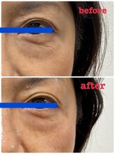 ナナラ(NANALA)/シワ、たるみ！REDショット☆