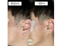 サロンロン 横浜関内(SALON RON)の雰囲気（もみあげのムダ毛脱毛でスッキリ綺麗な横顔美人！！）