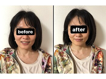 キュープ 富山店(Qpu)/小顔矯正