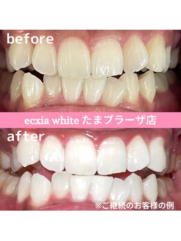 エクシアホワイトニング たまプラーザ店/ビフォーアフター