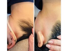 スワフルール(soi Fleur)/美人うなじ脱毛