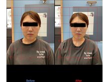 エミット(emit)/小顔矯正